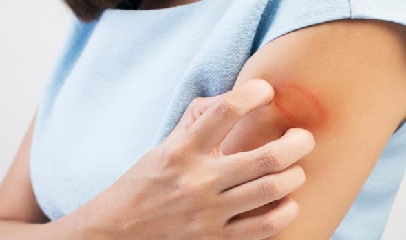  العرب اليوم - لحروق الجلد في المنام تفسيرات ودلالات غير متوقعة